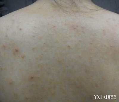 夏天背上起了很多痘痘