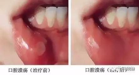 口腔溃疡怎样治疗