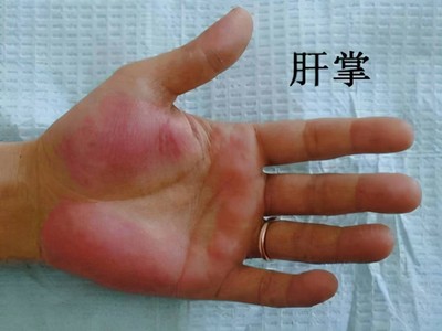 蜘蛛痣怎么治疗