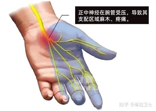 右手发麻是怎么回事