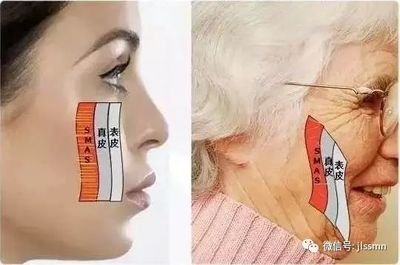 热拉提可以瘦脸吗