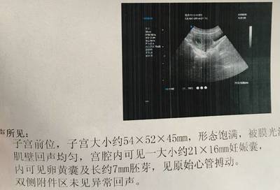 怀孕45天有什么症状
