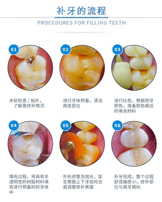 补牙整套多少钱