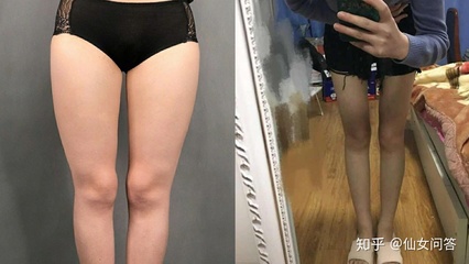 大腿抽脂三天后的照片