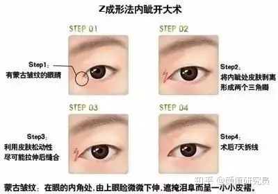 好看的内眦双眼皮