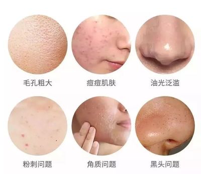 毛孔粗大有黑头粉刺怎么办