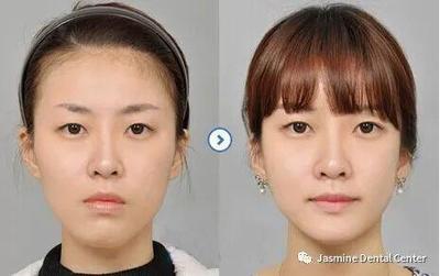 脸型变化