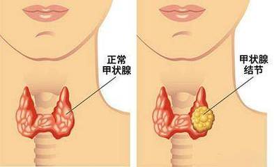 左右甲状腺正常厚约多少钱