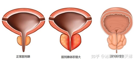 看前列腺肥大要多少钱