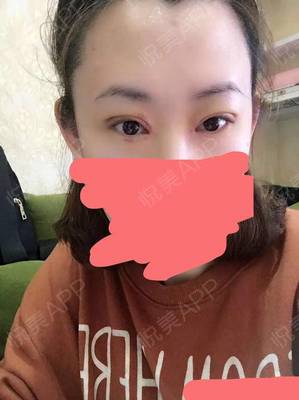 做双眼皮淤青多久能好
