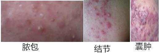 结节痘痘怎么治疗最好