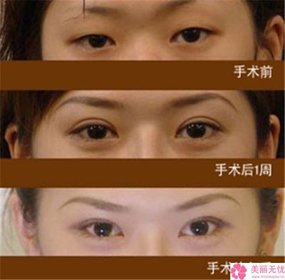 郑州韩式双眼皮