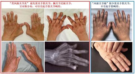 手指关节炎怎么治疗