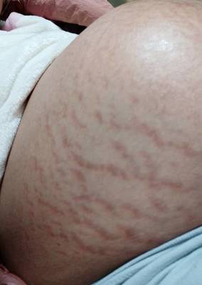 怀孕多久妊娠纹会出现