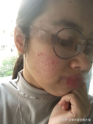 后青春期长痘痘怎么办