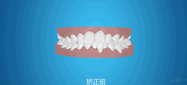 金属过敏能做牙齿矫正