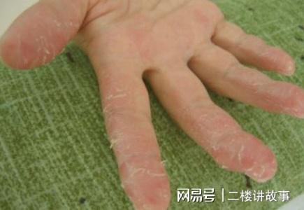 汗疱疹怎么治疗