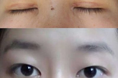 蛋白线双眼皮是永久的吗