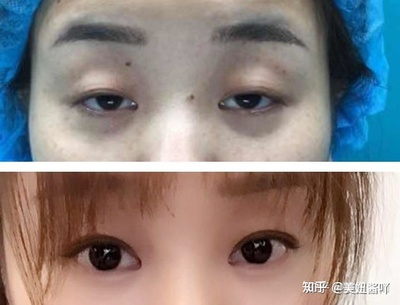 割双眼皮需要多久恢复