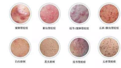 囊肿痤疮怎么治疗
