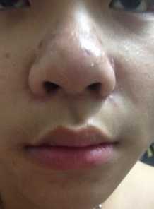 熬夜鼻头长痘痘怎么办