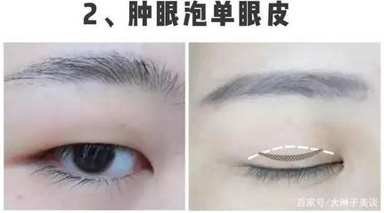 单眼皮肿眼泡怎么贴双眼皮