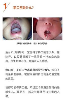 宝宝有口疮怎么办
