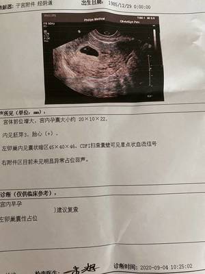 怀孕卵巢囊肿怎么办