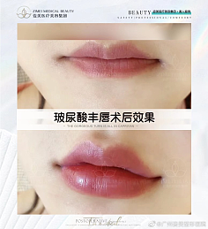 丰唇玻尿酸