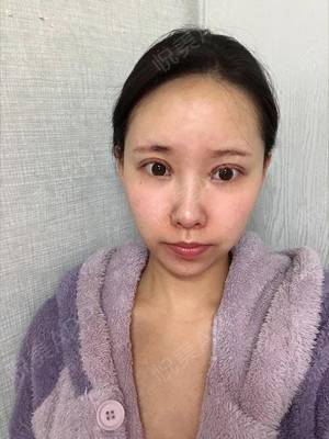 双眼皮疤痕多久才淡化