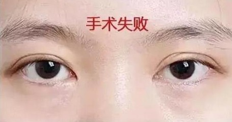 割双眼皮好看吗