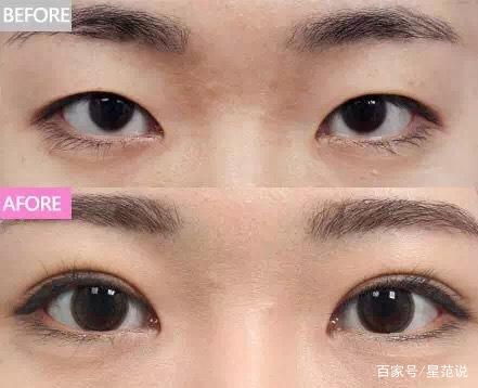 那个名星做过双眼皮