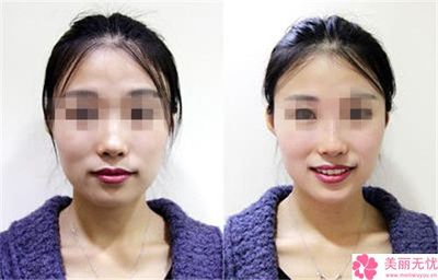 隆鼻效果怎么样