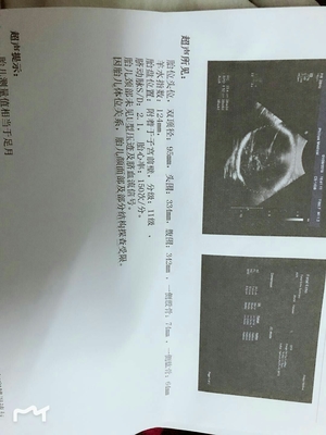 胎儿头偏大是什么原因