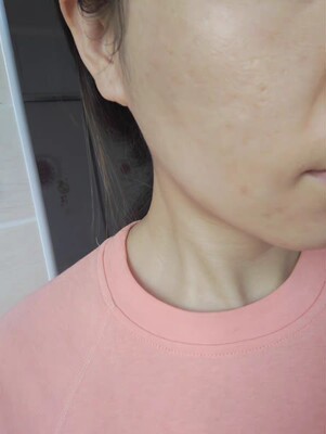 长痘痘用了补水面膜吗