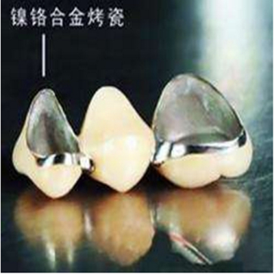合金烤瓷牙
