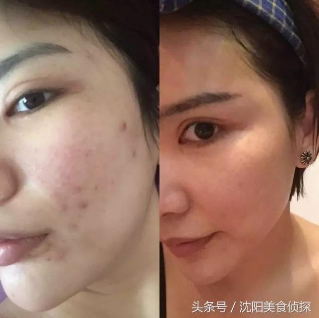 沈阳治痘痘出色肤康优