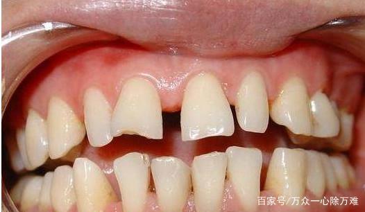 牙缝大怎么治疗