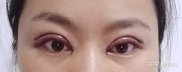 全切双眼皮恢复过程