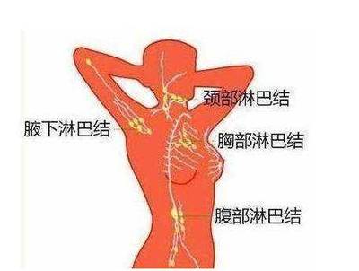 腹部淋巴结怎么治疗才能消除