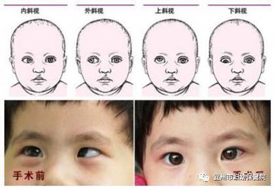小孩斜视怎么治疗