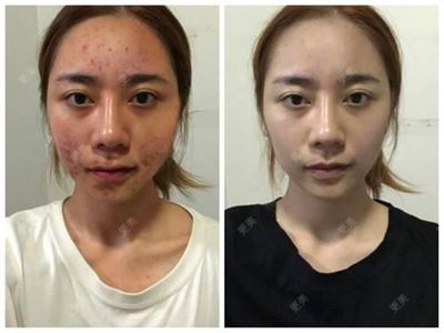 额头长痘痘能打肉毒素吗