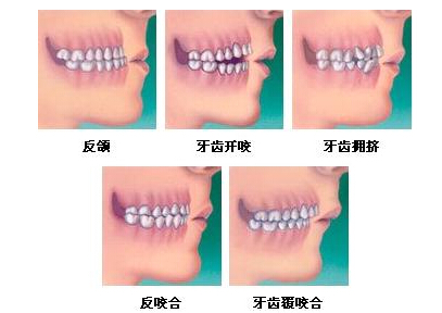 三十岁矫正牙齿要多久