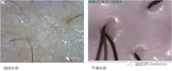 头皮里长疙瘩是怎么回事