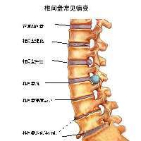 颈椎突出怎么治疗效果好