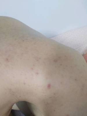 怀孕背部长痘痘怎么办