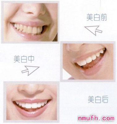 牙齿美白的副作用