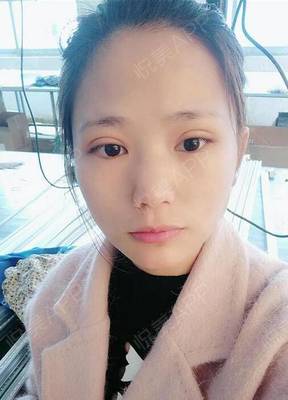 双眼皮术后多久可以洗脸