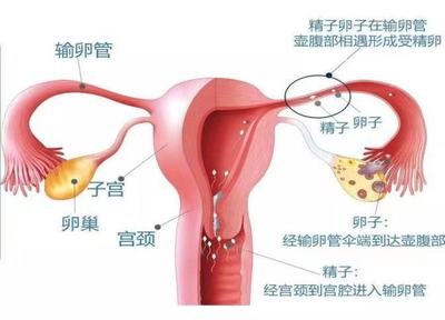 不孕怎么治疗