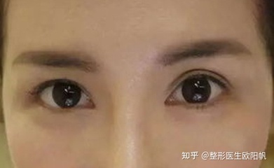 割完双眼皮恢复期